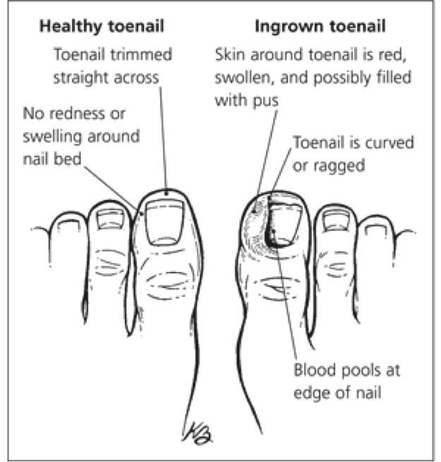 Toenail Hurts When Pressed: Causes and Treatment